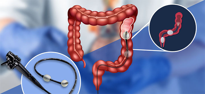 Çift Balon Enteroskopi veya Çift Balon Endoskopi Nedir, Niçin Yapılır?