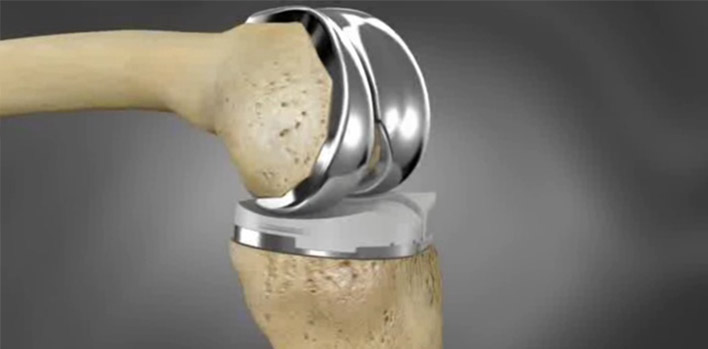 What is Knee Prosthesis? What is Knee Prosthesis?