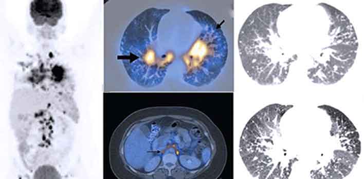 Ga 68 PSMA PET CT Imaging