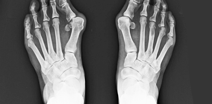 Halluks Valgus (Ayak Başparmağı Şekil Bozukluğu) Nedir?