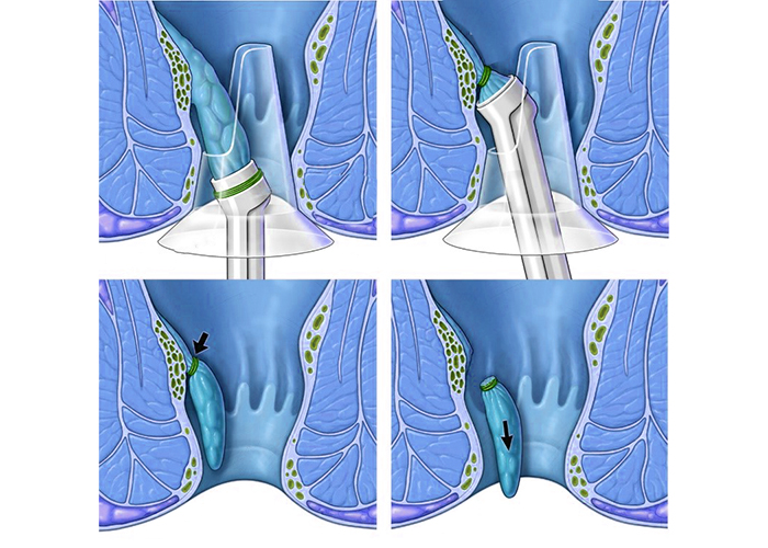 Hemoroid De Lastik Halka Takılması (Lastik Bant Ligasyonu) Tekniği İle Tedavi Hemoroid De Lastik Halka Takılması (Lastik Bant Ligasyonu) Tekniği İle Tedavi