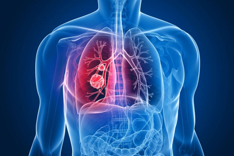 Is 90% Treatment Success For Lung Cancer Possible? Is 90% Treatment Success For Lung Cancer Possible?