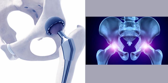 What is Hip Joint Calcification and Hip Prosthesis?