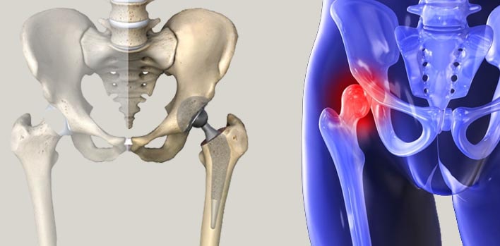 Kalça Protezi Ameliyatı Sonrası Dikkat Edilmesi Gerekenler