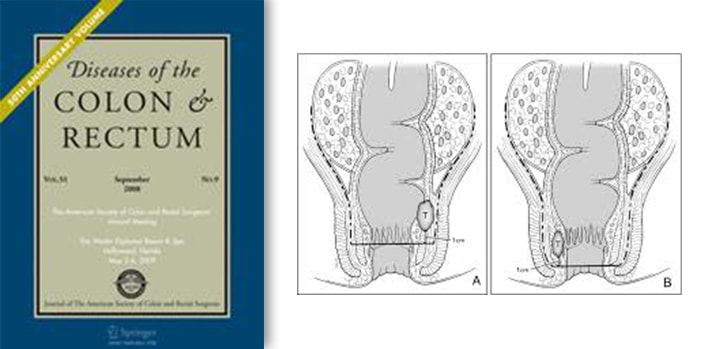 Can the post-operative bag-related life be prevented in the end-stage tumors of the large intestine?