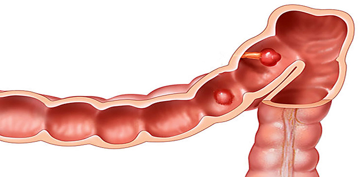 The Importance of Colonoscopy