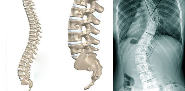 Skolyozda Tanı ve Değerlendirme 